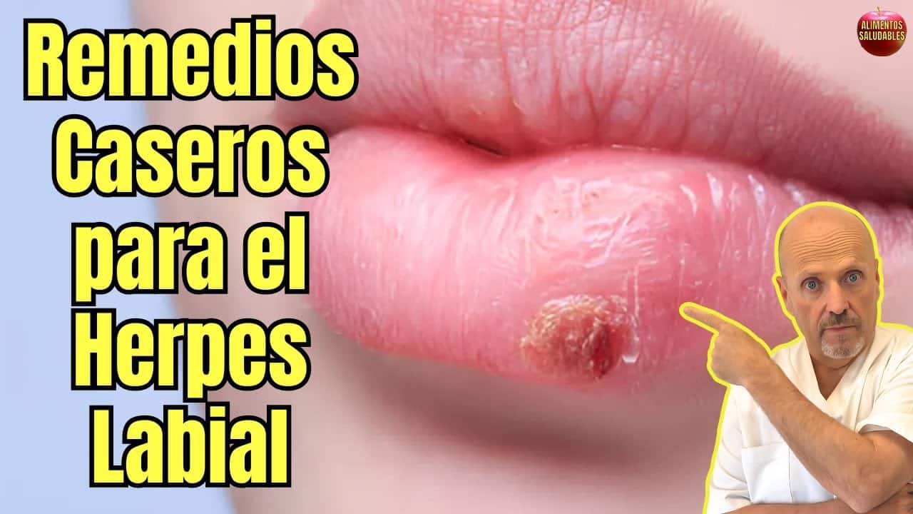 Remedios Caseros Para El Herpes Labial